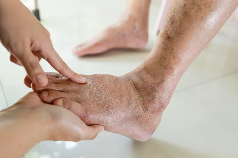 Sucha skóra na nogach u starszych osób objawy