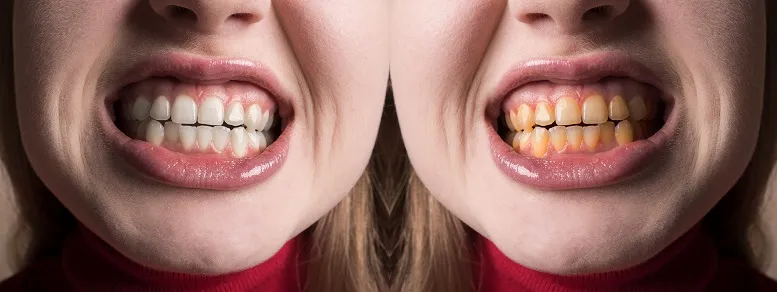 piaskowanie zębów efekt