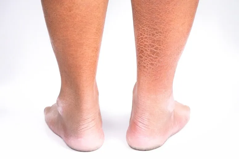 Jak zadbać o suchą skórę na nogach