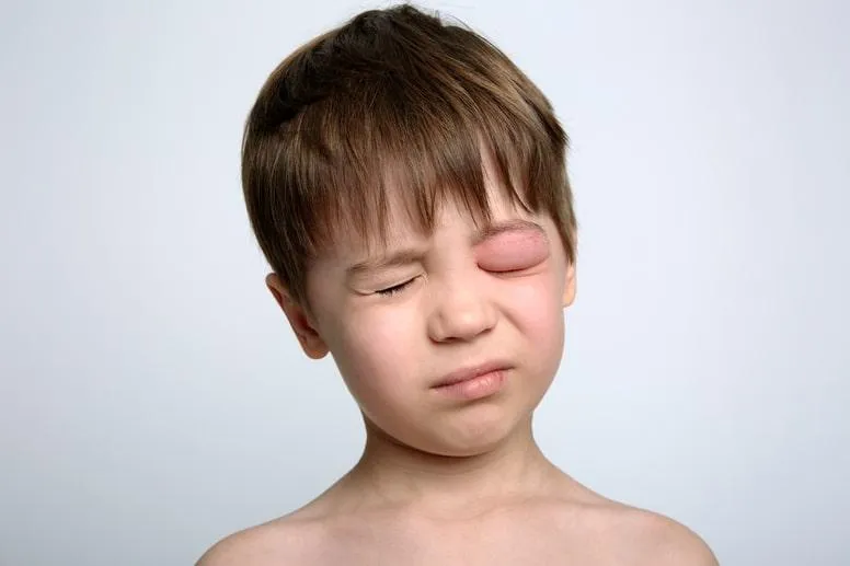 Spuchnięte oko u dziecka – jakie są przyczyny i jak zaradzić opuchniętym powiekom?