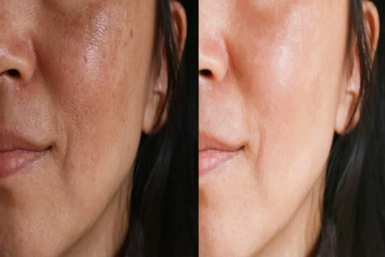 Jak zapobiegać przebarwieniom na twarzy? Skuteczne sposoby na przebarwienia na twarzy