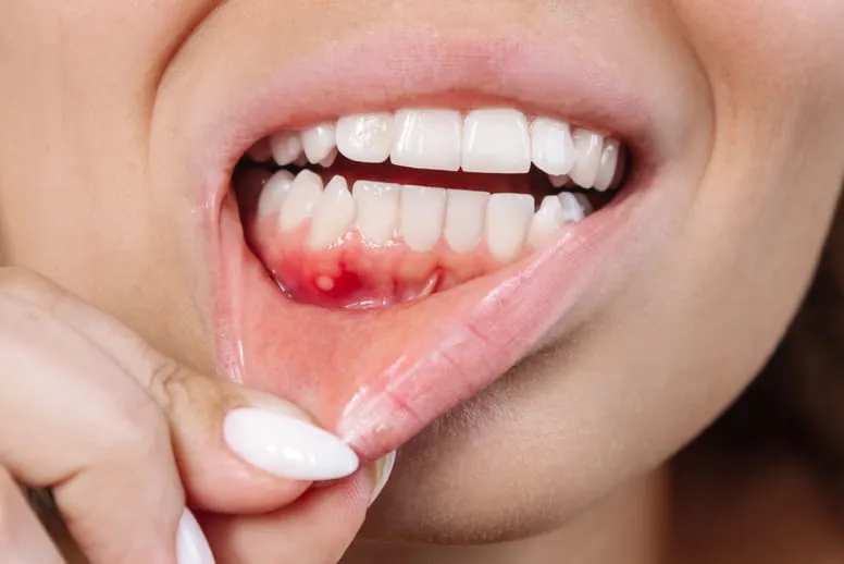 Owrzodzenia jamy ustnej leczenie