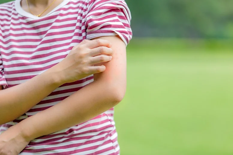 opuchlizna po ukąszeniu owada domowe sposoby