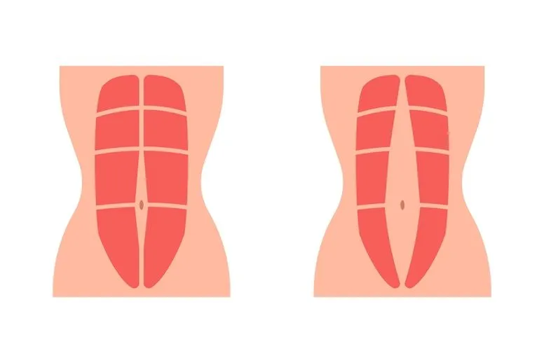 Rozejście mięśnia prostego brzucha – przyczyny, objawy i leczenie. Jak zapobiegać rozstępowi mięśni prostych brzucha?