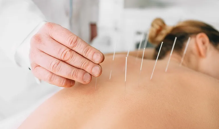 Niefarmakologiczne sposoby leczenia ­bólu  akupunktura
