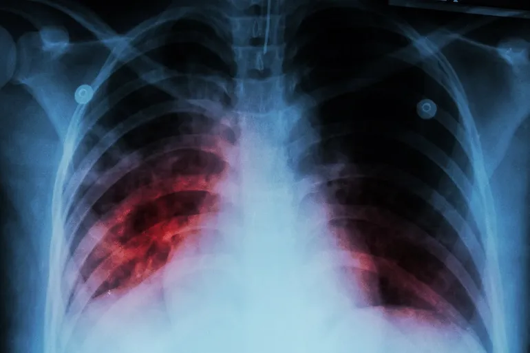 RTG przy zapaleniu płuc
