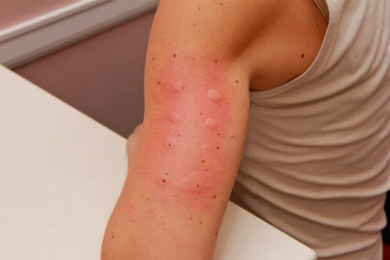 alergia na skórze testy alergiczne