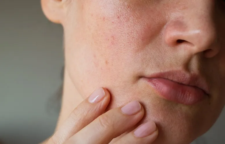 objawy trądziku kosmetycznego - skóra twarzy