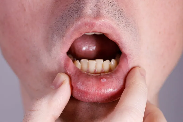 Rany w jamie ustnej przyczyny
