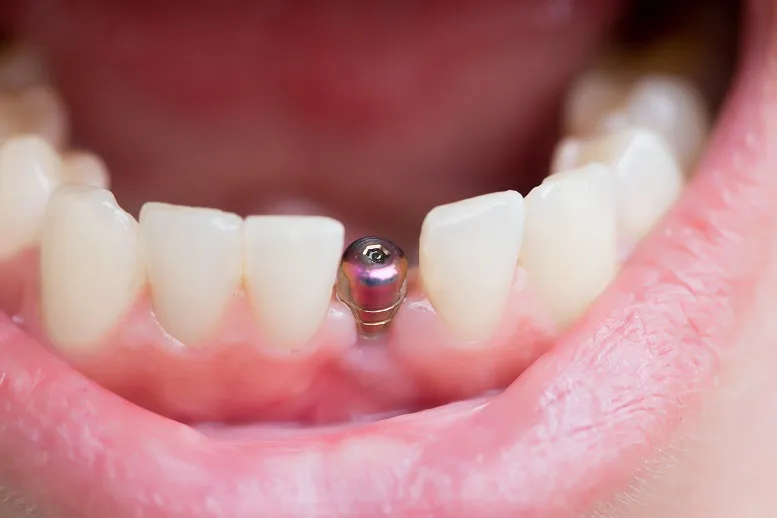 Implant zęba − kiedy trzeba go wszczepić?