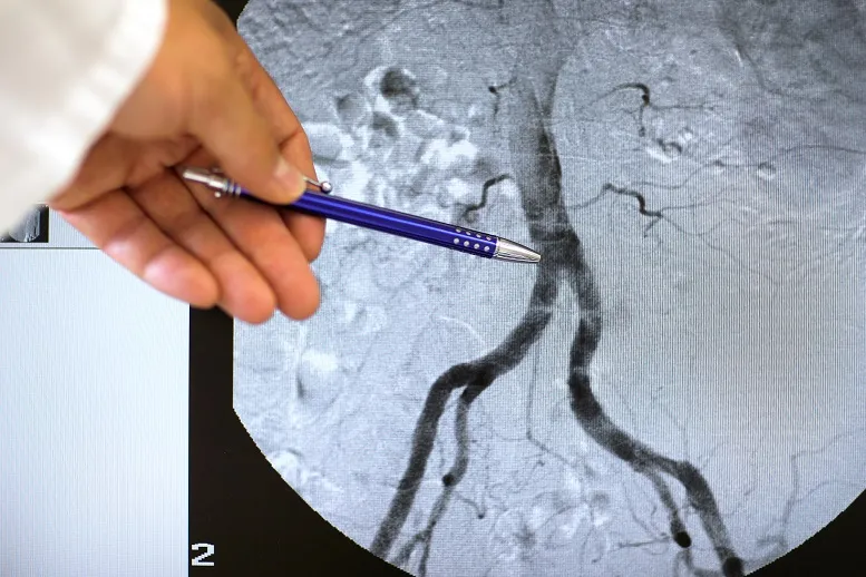 Tętniak aorty brzusznej − jak wygląda leczenie?