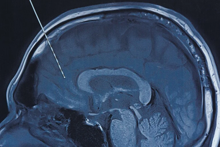 leczenie operacyjne parkinsona