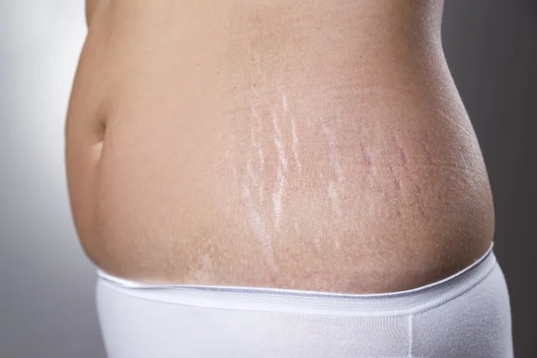 ¿Es posible hacerse un tatuaje en el estómago después del embarazo?