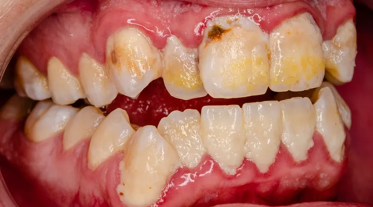 żółte zęby przyczyny
