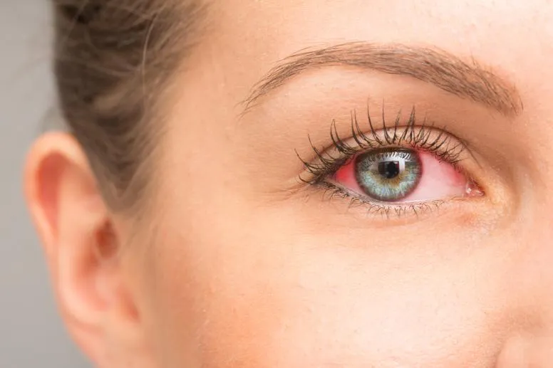 Przekrwione oczy – czy to groźny objaw? Poznaj przyczyny