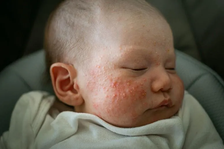 Trądzik niemowlęcy – jak go rozpoznać i jak leczyć?