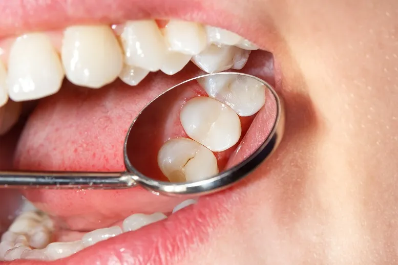 Ubytki w zębach − skąd się biorą?
