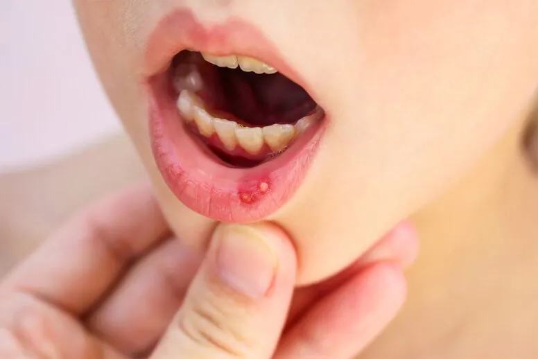 Zapalenie jamy ustnej u dziecka – objawy 
